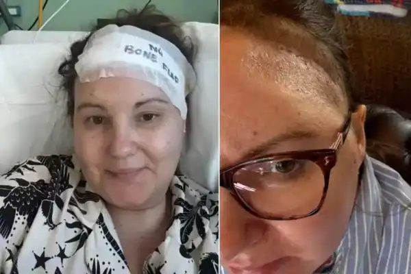 Mulher descobre que tumor cerebral se desenvolveu por 20 anos em sua cabeça
