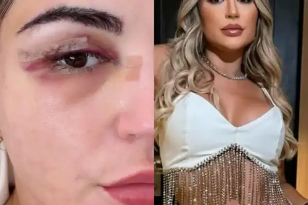 Deolane aparece com olho roxo e assusta a web; razão é esclarecida