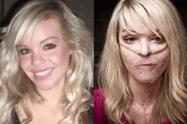 Apresentadora e modelo sofre ataque brutal com ácido e tem vida transformada para sempre