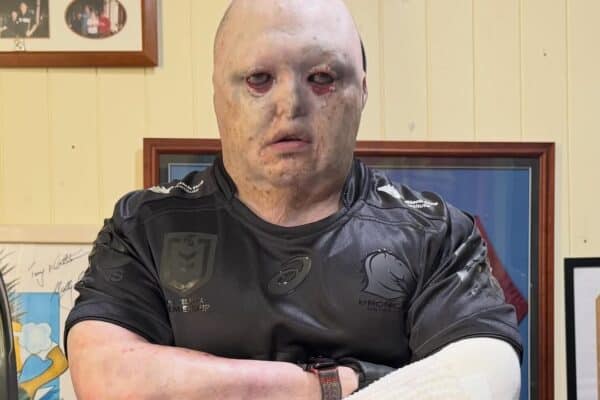 Homem com doença rara denuncia que IA da Meta descreveu sua foto como “zumbi”