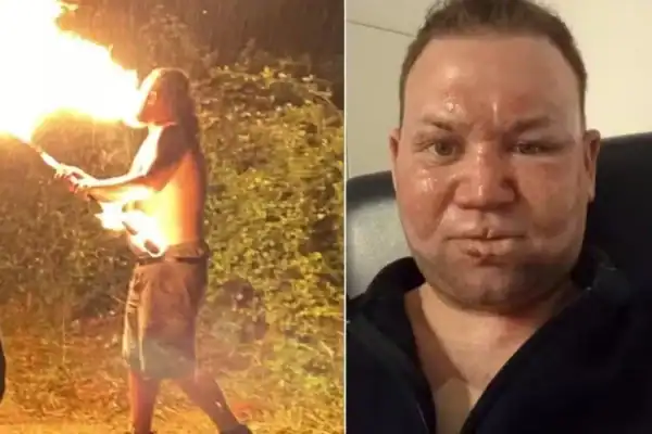 Cuspidor de fogo tem rosto queimado em acidente grave durante apresentação improvisada