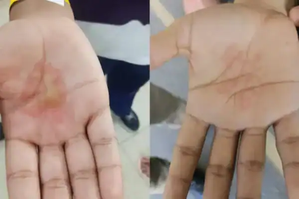 Pai é detido por torturar filhos com comida fervendo em retaliação à companheira