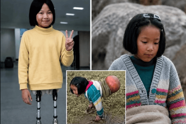 Menina que usava bola de basquete para andar realiza sonho e recebe próteses nas pernas
